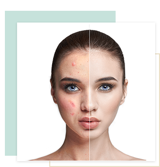 Hydra touch aknés, szeborreás bőr kezelés, Budapest, 16.kerület, kozmetika